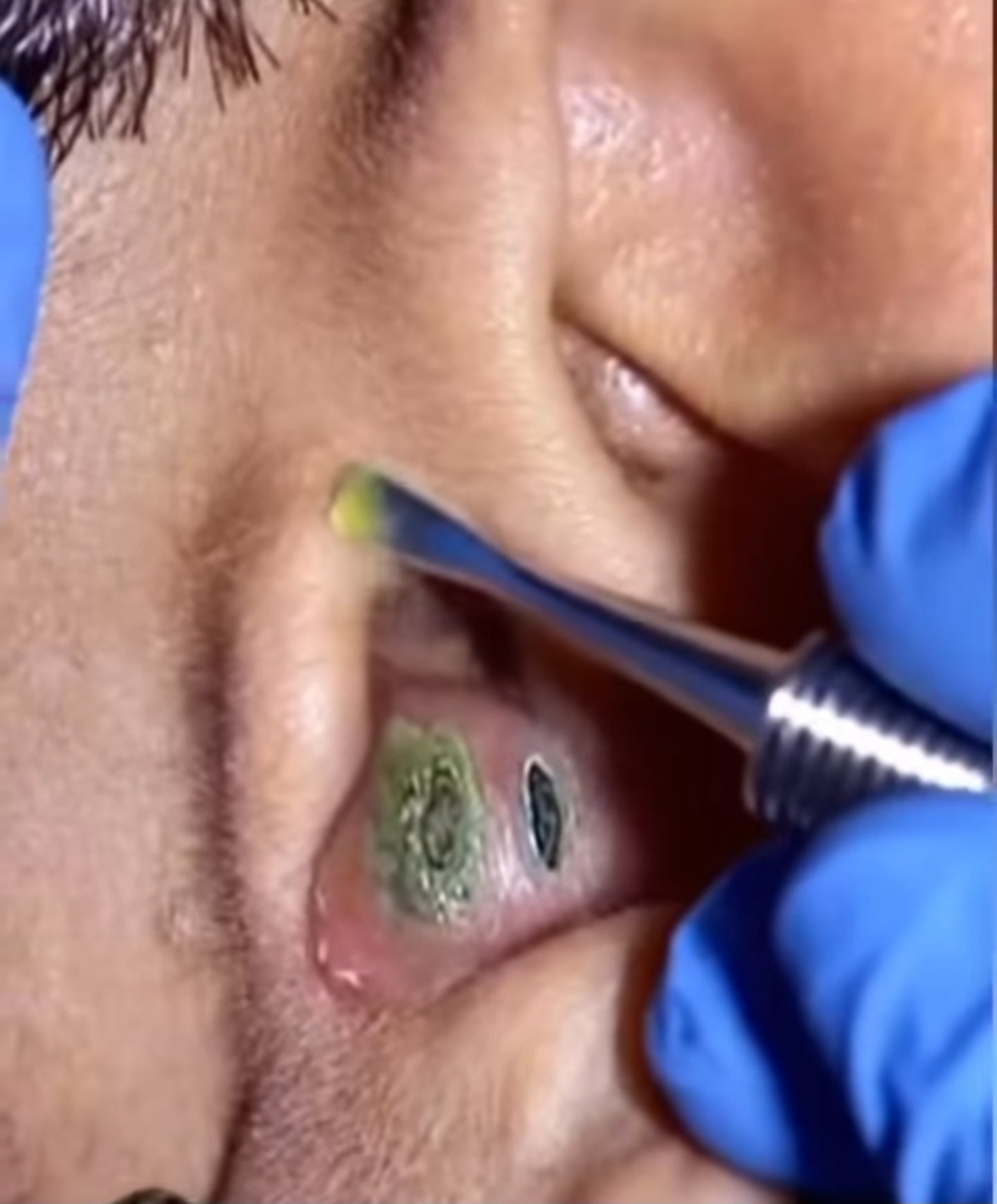 Body Acne: 10 Tips To Get Rid Of Them